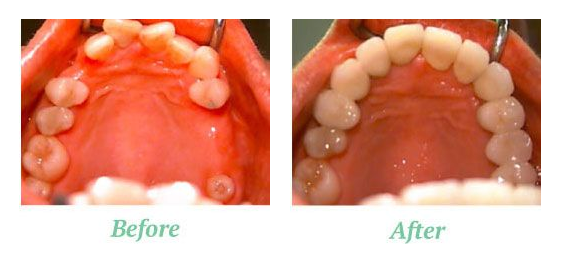 beforeafter-implants