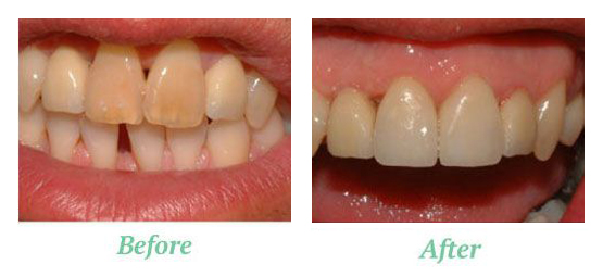 beforeafterwhitening