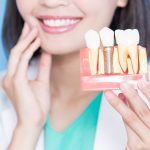 dental implants vs veneers