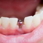 are dental implants safe