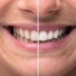 how often should you whiten your teeth