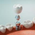 dental implants benefits