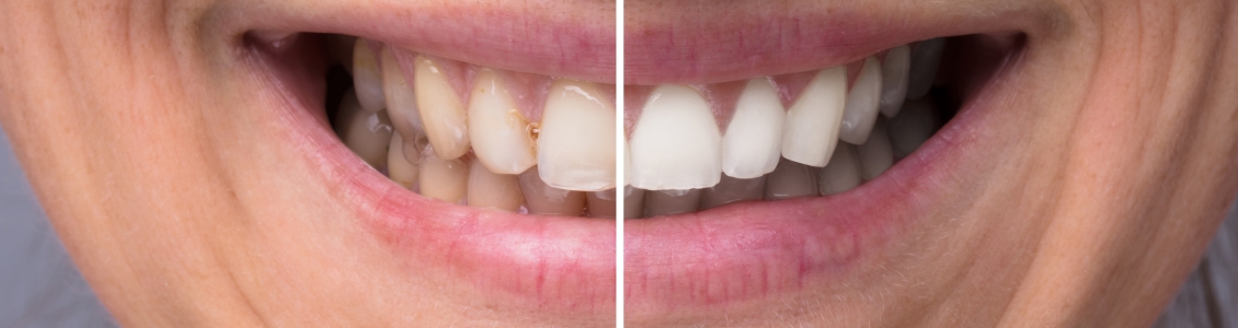 How to whiten teeth bonding